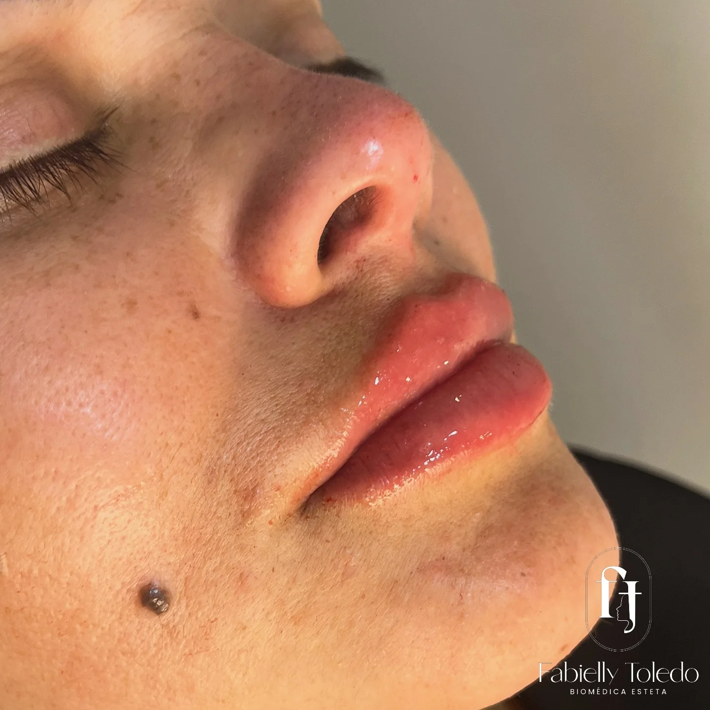 Resultado natural de preenchimento labial