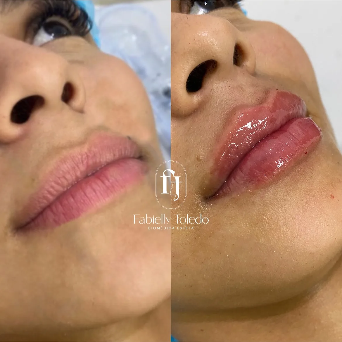 Preenchimento Labial: Preenchimento labial com volume e contorno na medida certa, realçando o sorriso com naturalidade.