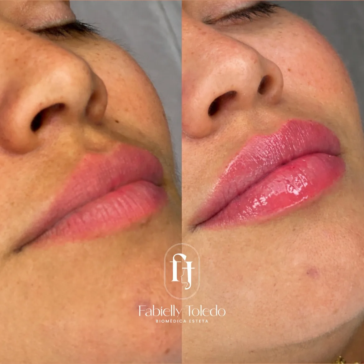 Preenchimento Labial: Lábios definidos com naturalidade, harmonia e a hidratação na medida certa.