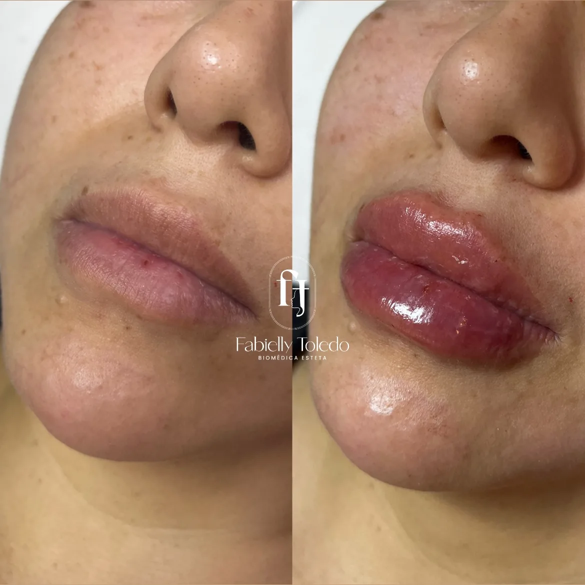 Preenchimento Labial: Contorno corrigido e volume equilibrado, com um resultado leve e elegante.