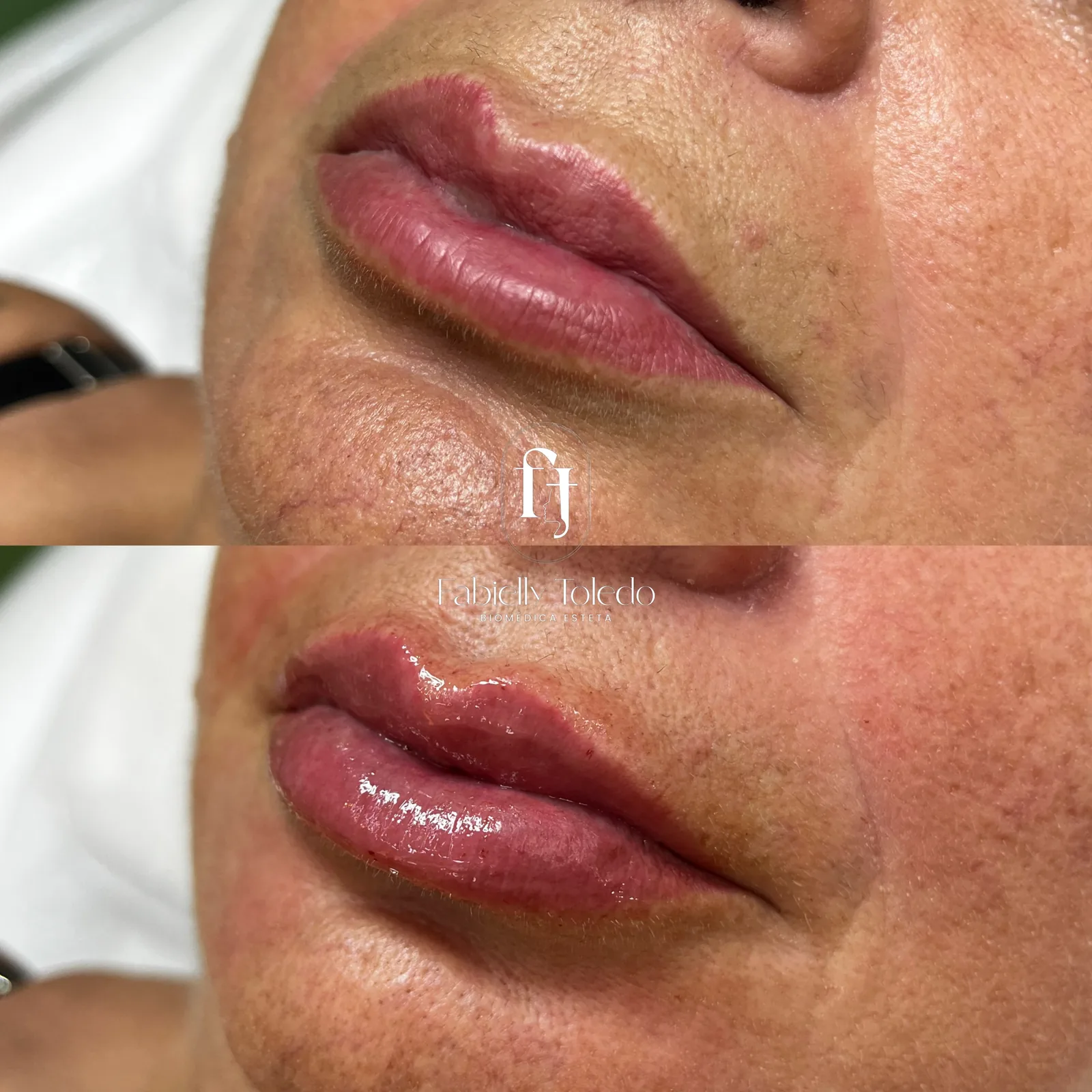 Correção Labial: Correção de assimetria de um preenchimento antigo, devolvendo equilíbrio e lábios harmônicos.