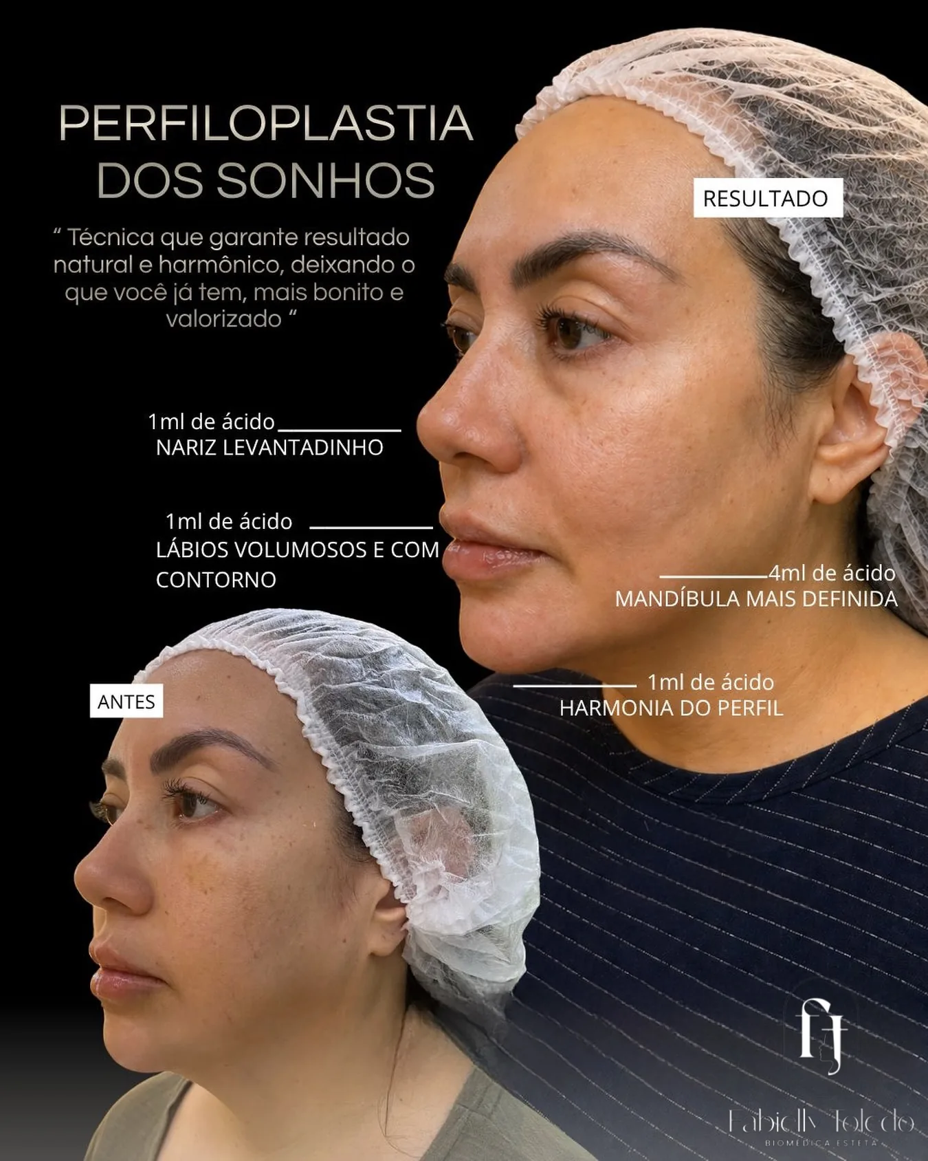 Harmonização de Perfil: Perfiloplastia completa: nariz, lábios e mandíbula trabalhados em harmonia, com aspecto natural.