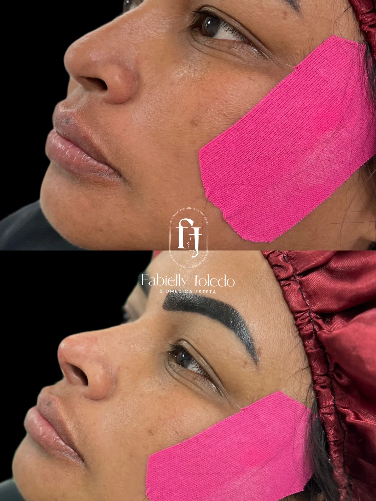 Rinomodelação: Rinomodelação valorizando o contorno do nariz, com um resultado natural e harmônico.