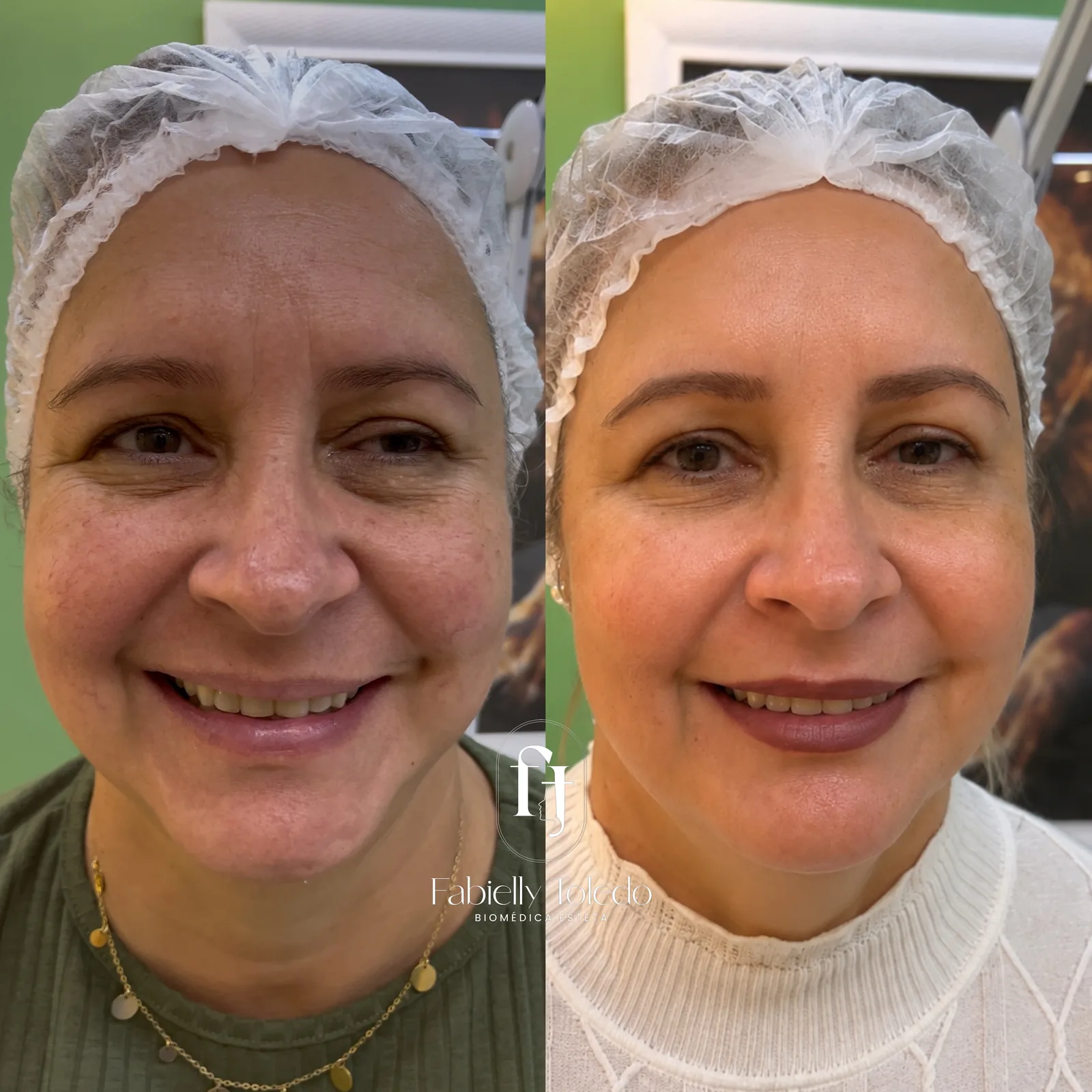 Rejuvenescimento: Rosto com aparência mais descansada e rejuvenescida, suavizando as linhas sem perder a naturalidade.